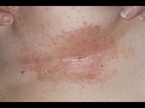 Diagnosis: Skin Rash Diagnosis Pictures