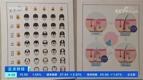 年轻人脱发年龄提前了20年 植发市场火爆】如今脱发已有年轻化趋势。国家卫健委2019年的调查数据显示，我国脱发人数超25亿，平均每6人中就