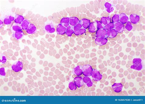 Acute Promyelocytic Leukemia