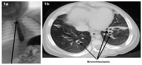 A Barium Study Showing Severe Gastro Esophageal Reflux Disease Gerd