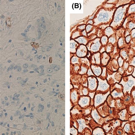 Immunohistochemical Staining Of Tm In Pancreatic Ductal Adenocarcinoma