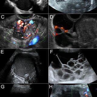 Examples of ultrasound features of adnexal masses; (A) serous ...