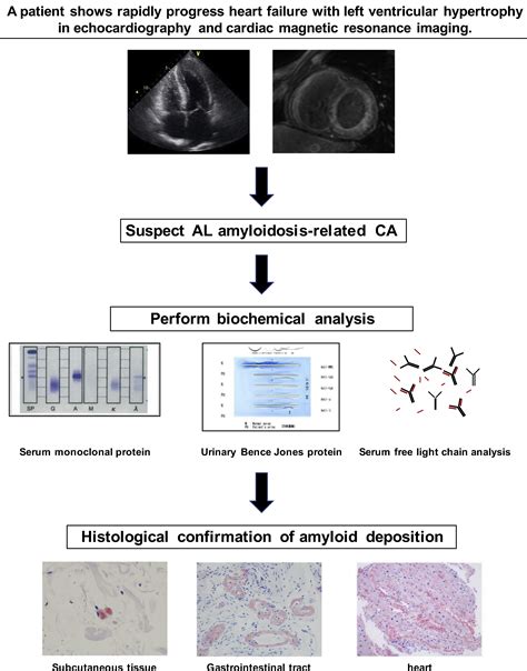 Recent Advances In Diagnosis And Treatment Of Cardiac Amyloidosis