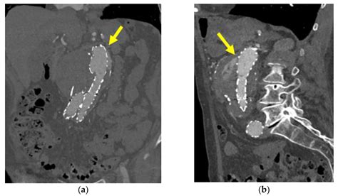 Embolization For Type Ia Endoleak After Evar For Abdominal Aortic