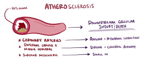 Atherosclerosis Treatment - Alternative Therapy