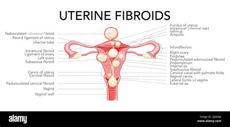 Uterine Fibroids Female Leiomyomas Reproductive System Uterus Diagram