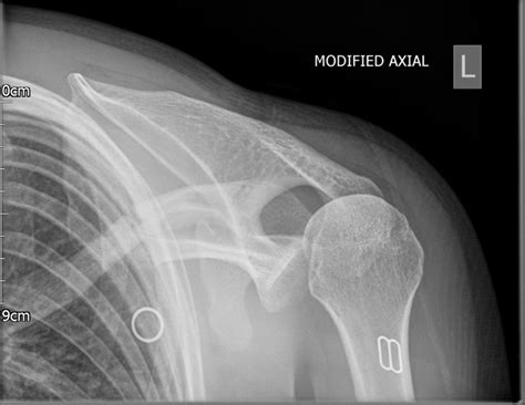 Posterior Shoulder Dislocation Its Worth Another Look Bmj Case Reports