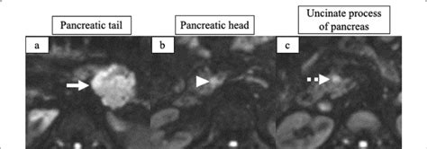 Mri Diffusion Weighted Imaging A The Tumor Located In The Pancreatic