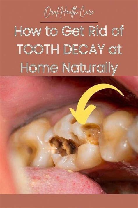 Get Rid Of Cavities And Tooth Decay Artofit