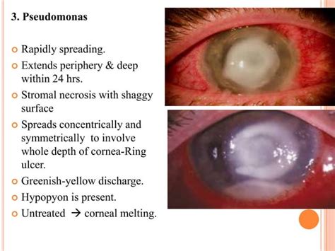 Bacterial Corneal Ulcer Drbp