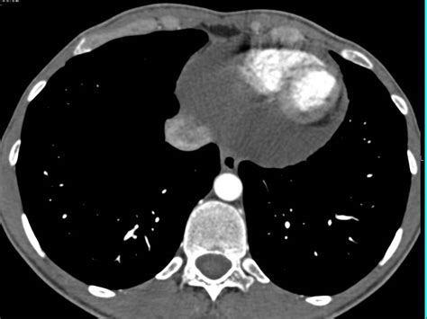 Pericardial Effusion And Incidental Hepatic Hemangioma Cardiac Case