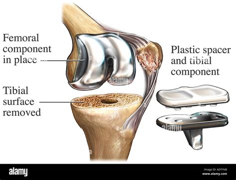 Total Knee Replacement Hi Res Stock Photography And Images Alamy