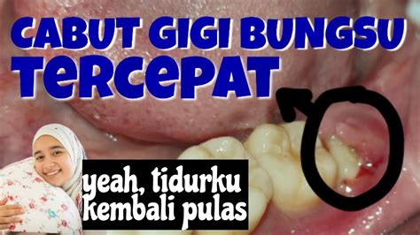 GIGI BUNGSU TUMBUH TERTUTUP GUSI Ini Proses Dicabutnya YouTube