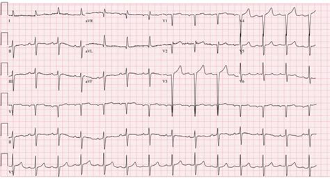 Baseline Ecg Ventricular Rate 81 Beats Per Minute Pr Interval 206