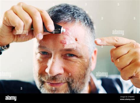 Man With Herpes Zoster Shingles On The Face Close Up Man Suffering