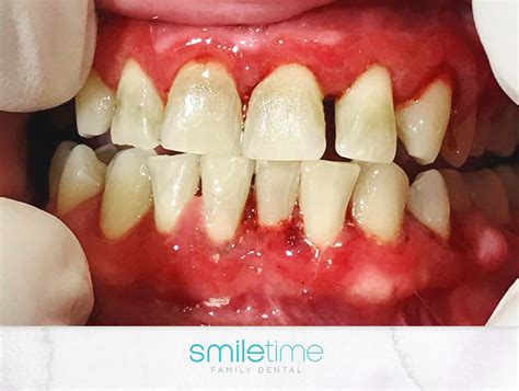 Case Studies Smile Makeover Gallery North Brisbane Dentist Photos