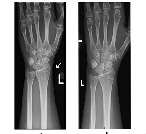 Image Of Adult Undisplaced Distal Radius Fracture Pre Splinting Image