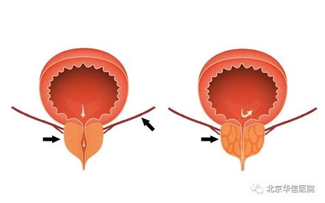治疗前列腺增生的新方法——一名患者的幸福自述手术