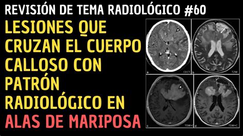 Revisión Tema 60 Lesiones que cruzan el cuerpo calloso con patrón