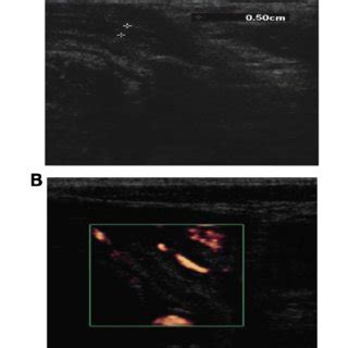 (A) Longitudinal segment of the colon showing loss of haustra. (B ...