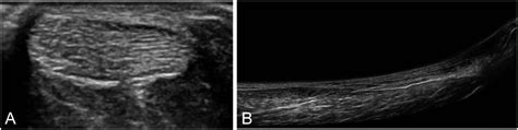 The Achilles Tendon In Healthy Subjects An Anthropometric And