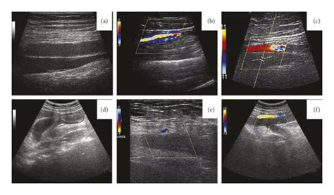 Ultrasound image of the veins of the lower extremities: (a∼c) normal... | Download Scientific ...