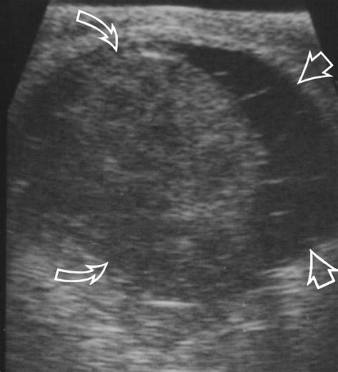 Tuberculous Epididymitis And Epididymo Orchitis Sonographic Appearances Ajr