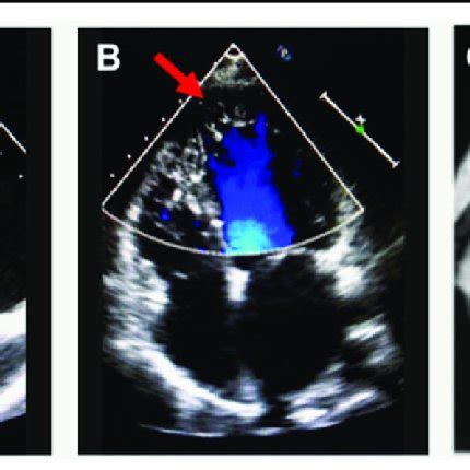 Echocardiogram And Cardiac Magnetic Resonance Imaging In LVNC Left