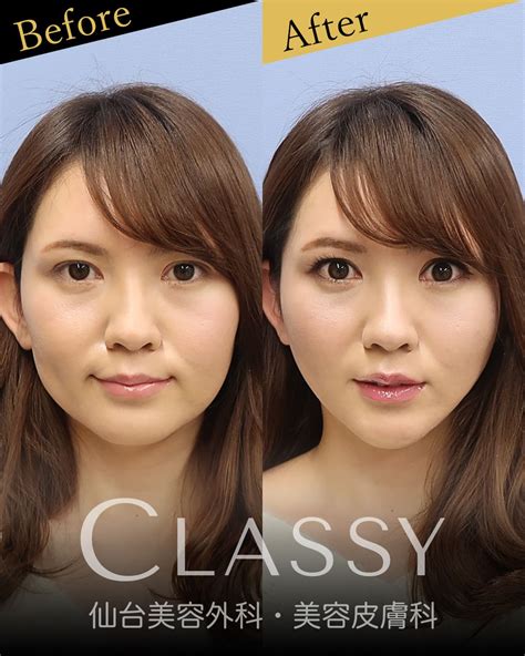 仙台で小顔にしたい！小顔vフェイスリフト（溶ける糸によるリフトアップ） Classy 仙台美容外科・美容皮膚科