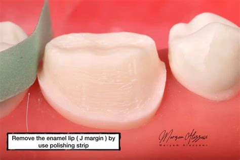 Zirconia Crown Preparation Myzerodonto