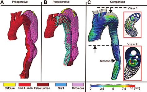 A 3d Reconstruction Of The Preoperative A And Postoperative B Download Scientific