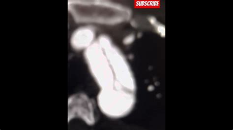 Windsock Sign Ct Aortogram Intimointimal Intussusception In Aortic Dissection Youtube