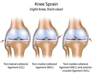 Anatomy of A Knee Injury Caused By Trauma — Los Angeles Personal Injury Attorney Blog — August 8 ...