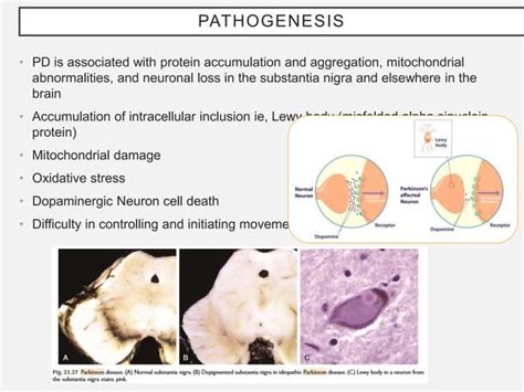 Pathophysiology Of Parkinsons Disease