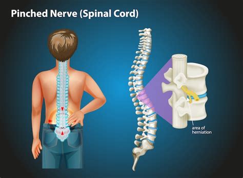 Free Vector | Diagram showing pinched nerve in human