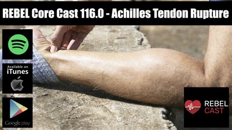 Rebel Core Cast Achilles Tendon Rupture Rebel Em Emergency