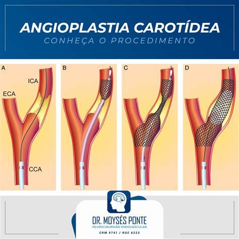 Angioplastia De Carótida Dr Moysés Ponte