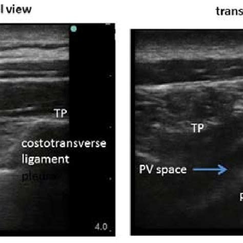 Anatomy Of Thoracic Paravertebral Space Pv Space Paravertebral Space