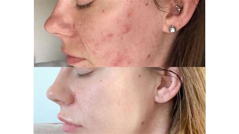 Tca Chemical Peel Before And After Edu Svet Gob Gt