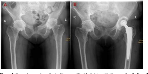 Pdf The Direct Anterior Approach Daa As A Standard Approach For