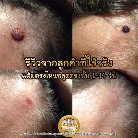 ครีมกำจัดไฝ ขี้แมลงวันติ่งเนื้อ หูด ตาปลา แก้ปัญหา กระ สิวหิน ครีมกำจัด