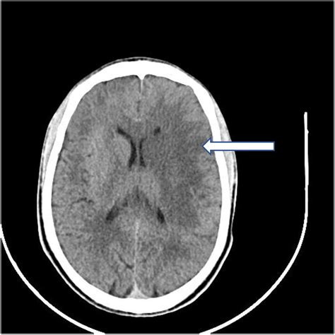 Non‐contrast Ct Scan Of The Head Showing A Left Fronto‐temporal