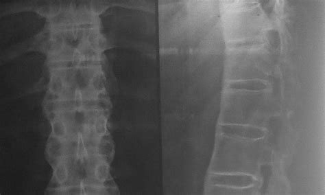 RESPIRATORY DISEASES by Dr. SHIV RAJ SHARMA: X ray of spine