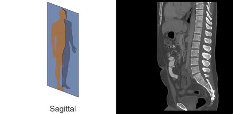 Abdominal Ct Bones Litfl Radiology Library