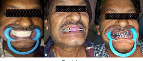 Figure 1 From Full Mouth Rehabilitation Of A Patient With Uneven