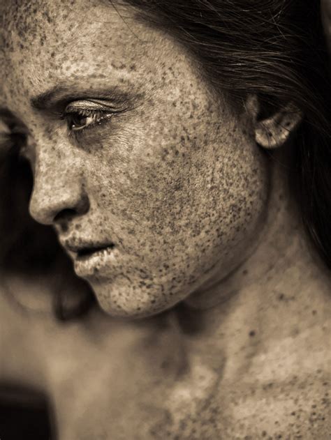 Freckles