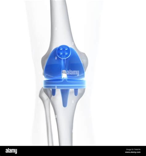 Knee Replacement Xray Hi Res Stock Photography And Images Alamy