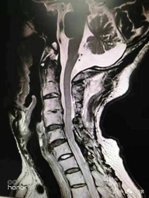 1952年做的一例頸椎管內腫瘤手術患者，尋求脊柱外科醫生幫忙 每日頭條