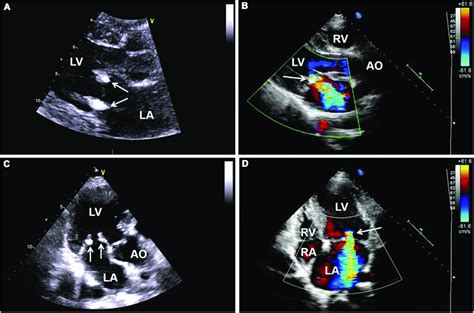 A C Follow Up Transthoracic Echocardiography Tte Demonstrating