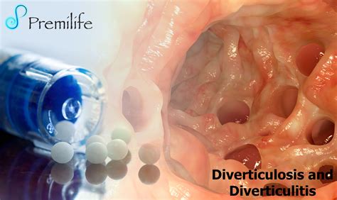 Diverticulosis And Diverticulitis Premilife Homeopathic Remedies